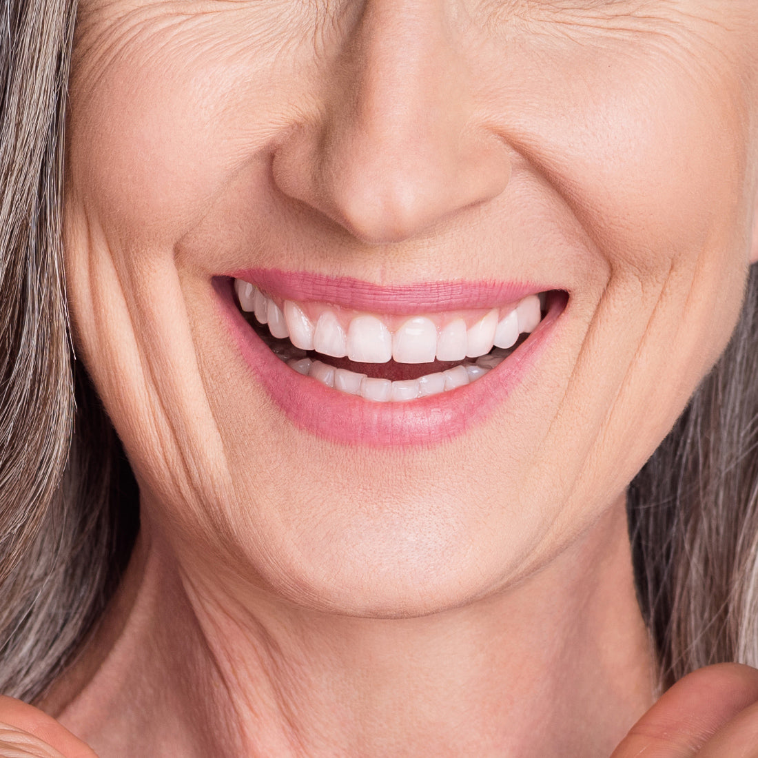 My Instant Veneers™ (Upper Only)